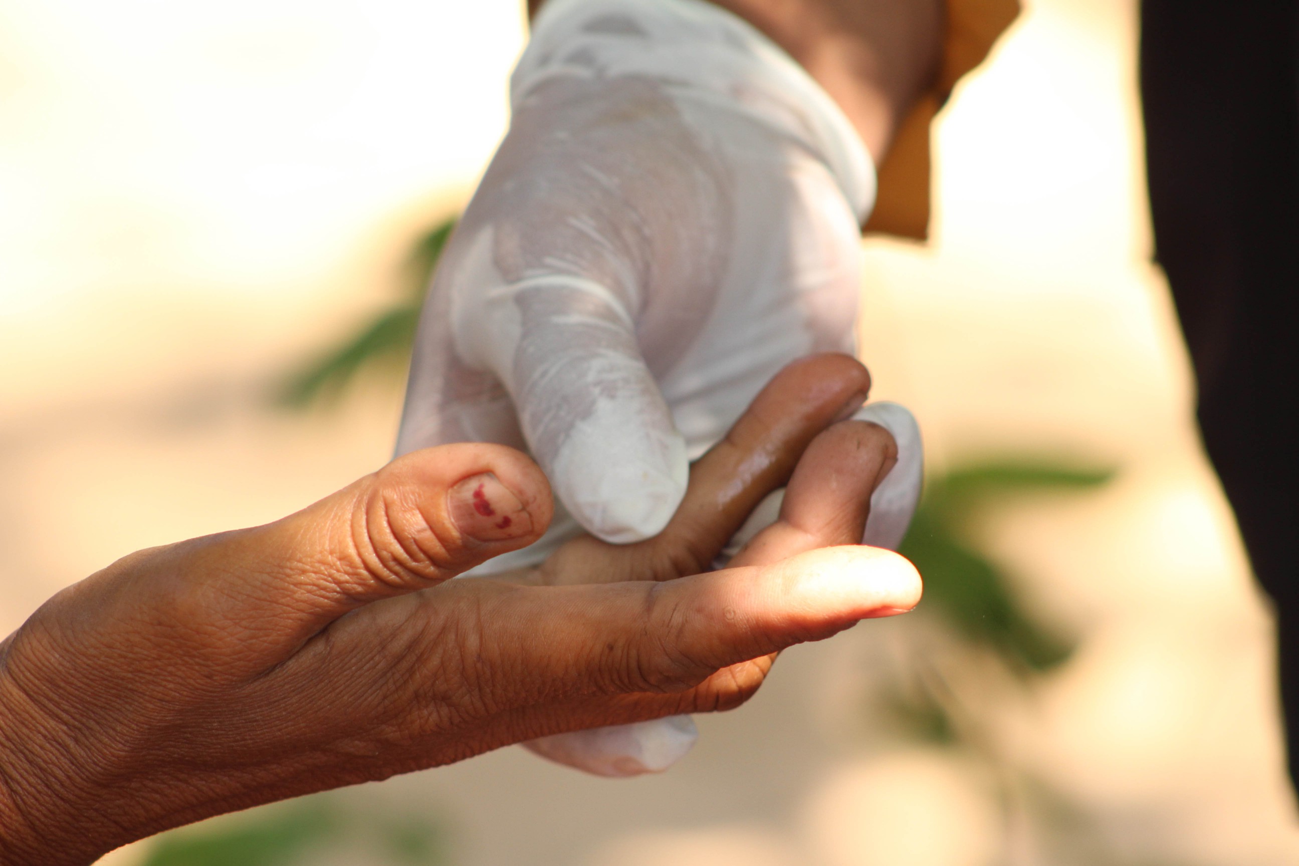 A mans hand held by another in a latex glove so that blood can be taken for a malaria test